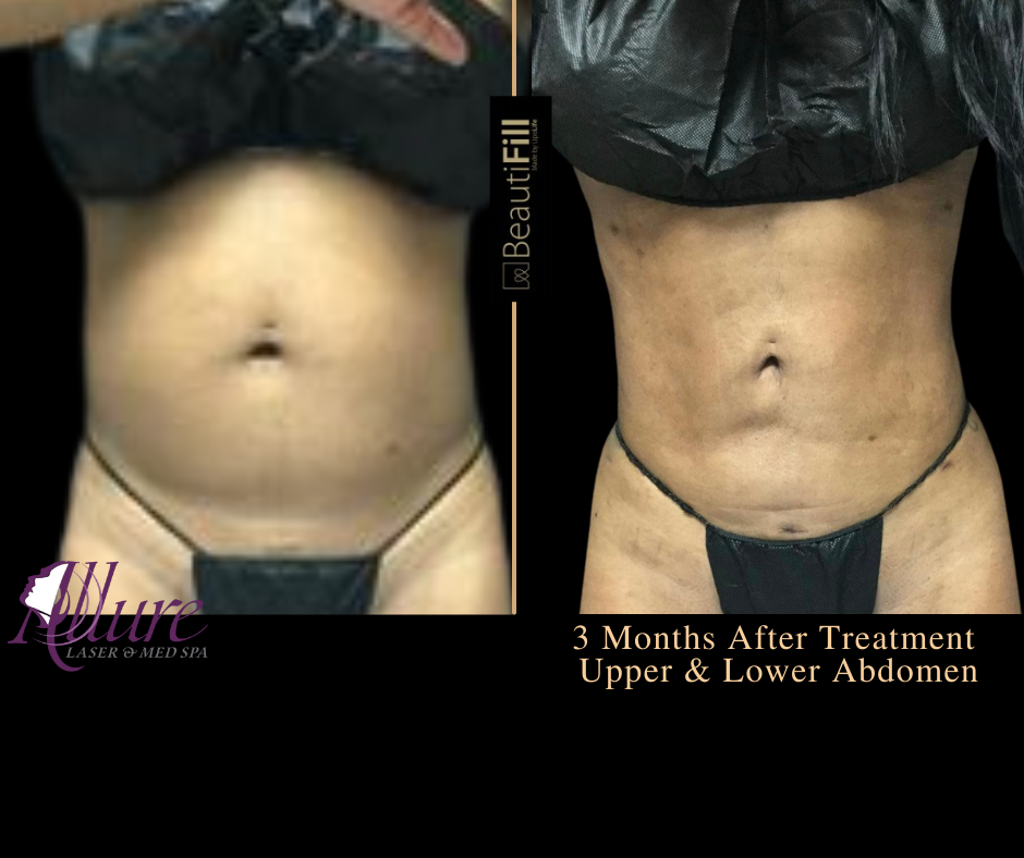 To Crystal Clear - BeautiFill1 - ABS, WAIST, FLANKS