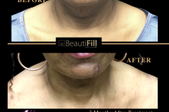 To Crystal Clear BeautiFill - CHIN, NECK, FACE