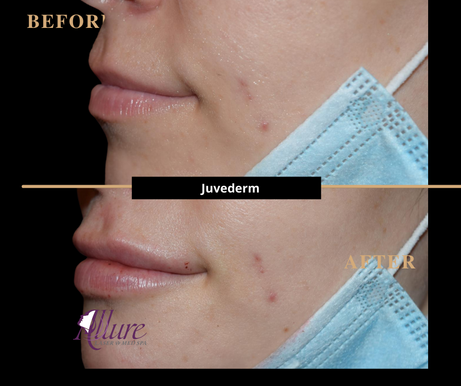 To Crystal Clr: Fillers (Juvederm, etc)